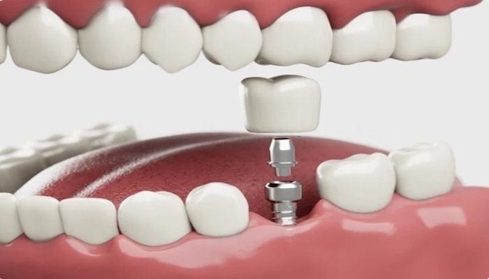 8 signs that you need dental implants